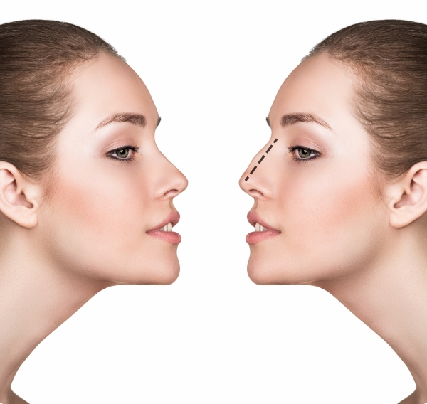 septoplasty and turbinate reduction before and after